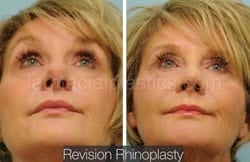 Rhinoplasty Before and After Plano, TX