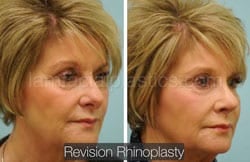 Rhinoplasty Before and After Plano, TX