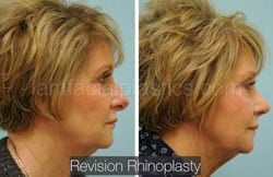 Rhinoplasty Before and After Plano, TX