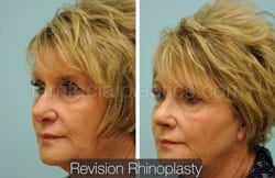 Rhinoplasty Before and After Plano, TX