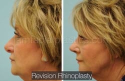 Rhinoplasty Before and After Plano, TX