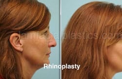 Rhinoplasty Before and After Plano, TX