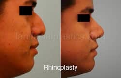 Rhinoplasty Before and After Plano, TX