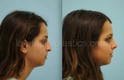 Rhinoplasty Before and After Plano, TX