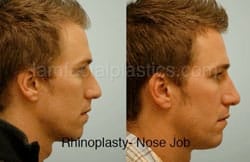 Rhinoplasty Before and After Plano, TX