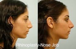 Rhinoplasty Before and After Plano, TX