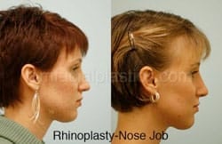 Rhinoplasty Before and After Plano, TX