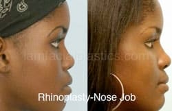 Rhinoplasty Before and After Plano, TX