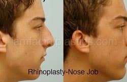 Rhinoplasty Before and After Plano, TX
