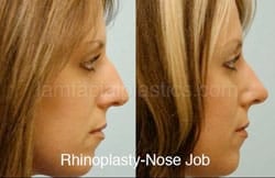 Rhinoplasty Before and After Plano, TX