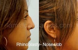 Rhinoplasty Before and After Plano, TX
