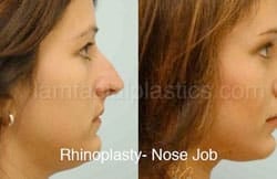 Rhinoplasty Before and After Plano, TX