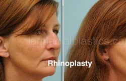 Rhinoplasty Before and After Plano, TX