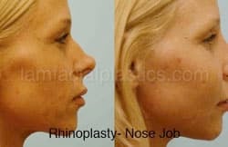 Rhinoplasty Before and After Plano, TX