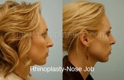 Rhinoplasty Before and After Plano, TX