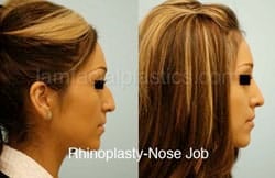 Rhinoplasty Before and After Plano, TX