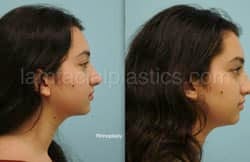 Rhinoplasty Before and After Plano, TX