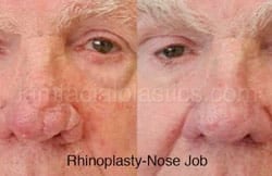 Rhinoplasty Before and After Plano, TX
