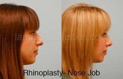 Rhinoplasty Before and After Plano, TX