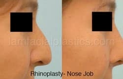 Rhinoplasty Before and After Plano, TX
