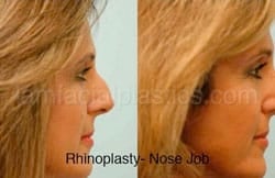 Rhinoplasty Before and After Plano, TX