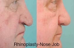 Rhinoplasty Before and After Plano, TX