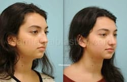 Rhinoplasty Before and After Plano, TX