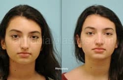 Rhinoplasty Before and After Plano, TX