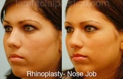Rhinoplasty Before and After Plano, TX