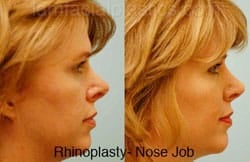 Rhinoplasty Before and After Plano, TX