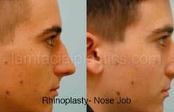 Rhinoplasty Before and After Plano, TX