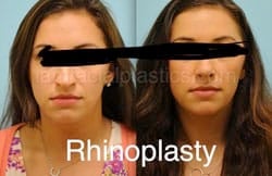 Rhinoplasty Before and After Plano, TX