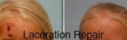 Scar Revision Before and After