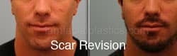 Scar Revision Before and After