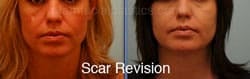Scar Revision Before and After