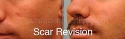 Scar Revision Before and After