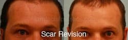 Scar Revision Before and After