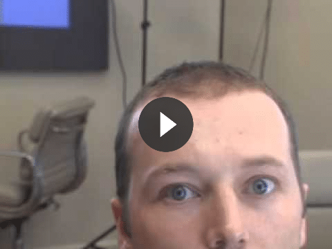scar revision video