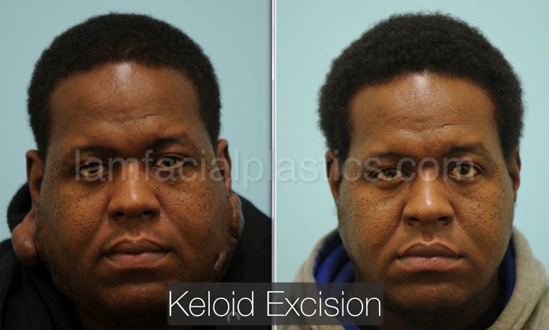 keloids bxa