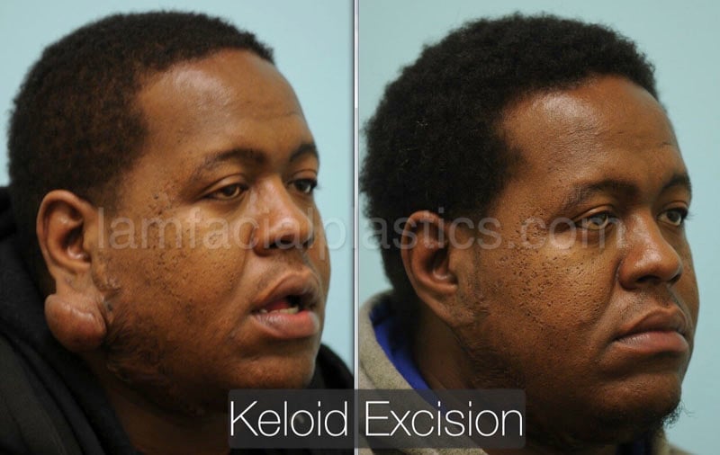 keloids bxa
