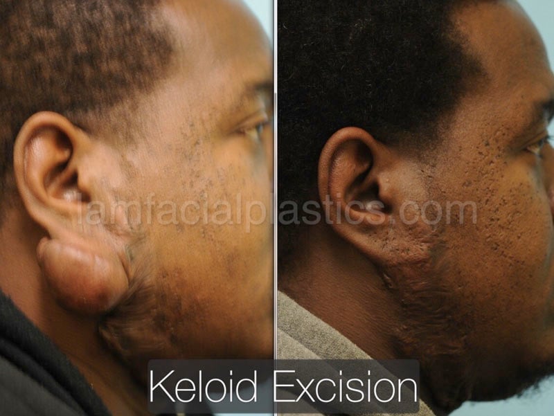 keloids bxa