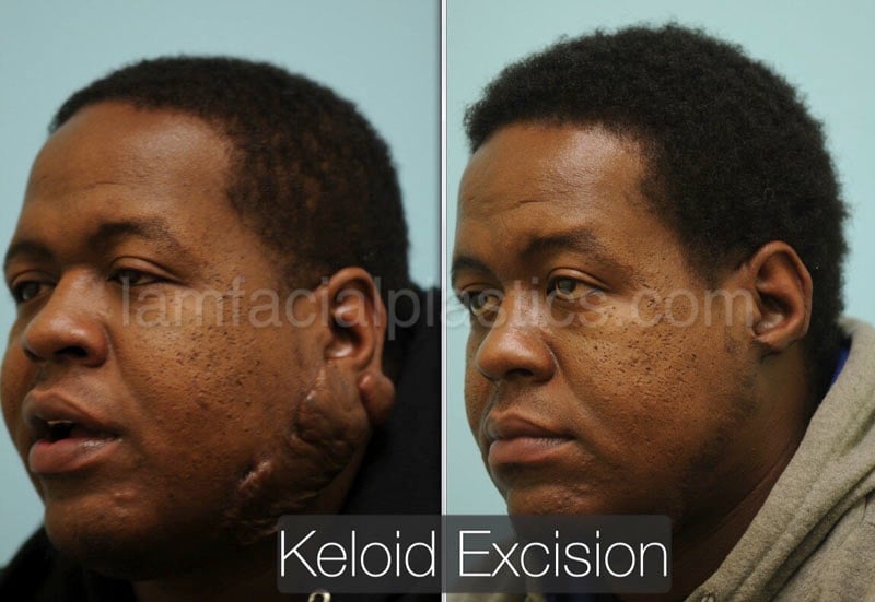 keloids bxa