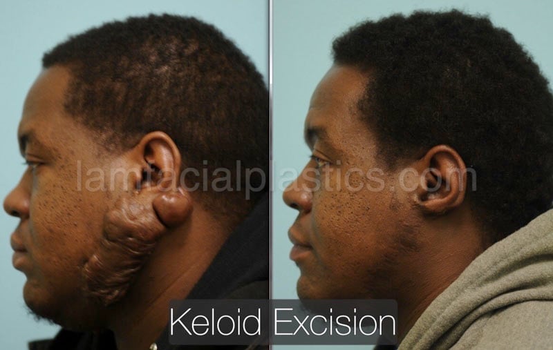 keloids bxa