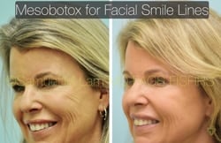 asian nose job asian nose job
