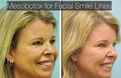 jaw reduction jaw reduction