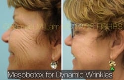 lip reduction lip reduction
