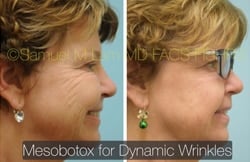 lip reduction lip reduction