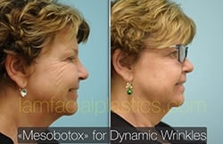 Botox Results Dallas