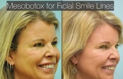 Botox Results Dallas