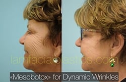 Botox Results Dallas
